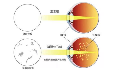 眼睛黑斑|飞蚊症